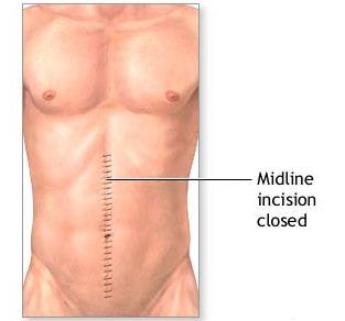 abdominal exploration aftercare picture