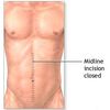 abdominal exploration aftercare picture